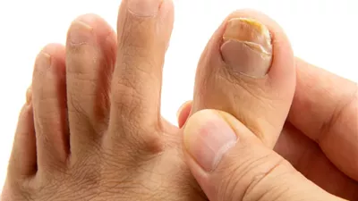 هؤلاء أكثر عرضة للإصابة بفطريات الأظافر