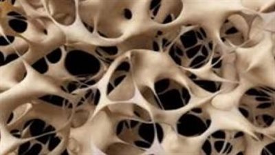 نصائح ذهبية للحماية من هشاشة العظام