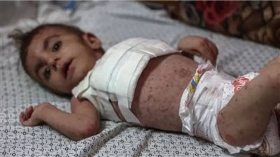 أمراض خطيرة تفتك بأطفال غزة