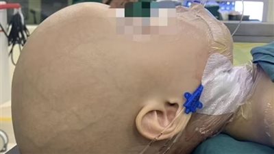 وفاة طفلة بعد اكتشاف جنين داخل جمجمتها 