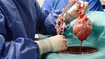 لأول مرة في العالم.. نجاح زراعة قلب يعمل بالتيتانيوم