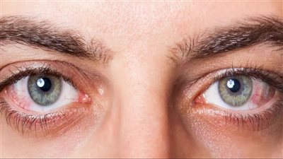 أسباب جفاف العين وطرق فعالة لعلاجها.. دليلك الشامل للتخفيف من الأعراض