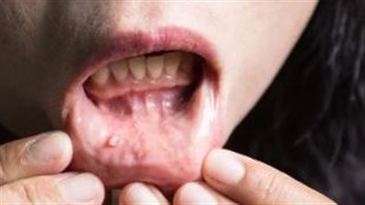 أعراض تدل على الإصابة بسرطان الفم