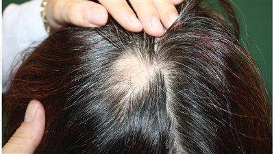 طبيب يكشف أسباب الثعلبة عند النساء في سن الخمسين