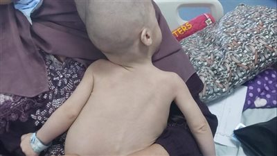 للمرة الأولى بجامعة الإسكندرية.. إجراء عملية نادرة لفصل توأم ملتصق