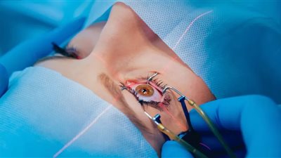 حكم زراعة العدسات الملونة عن طريق العمليات الجراحية