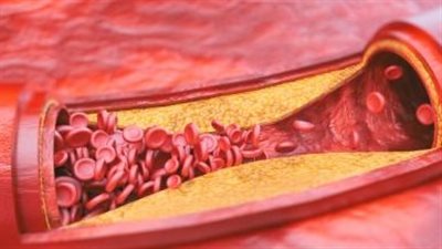 طبيب: تصلب الشرايين يمكن أن يحدث بدون أعراض