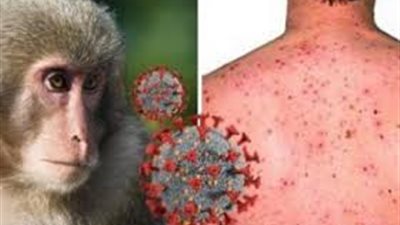 جدري القرود يضرب باكستان بأول حالة اليوم.. وزارة الصحة توضح