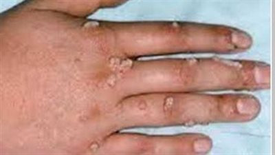 حسرة حول الدواء الرئيسي لجدري القردة