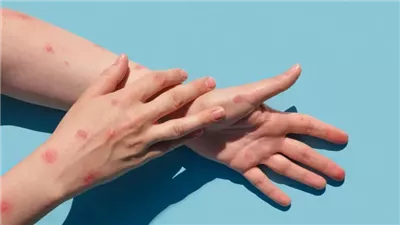 الصحة المغربية: عدم تسجيل أية حالة إصابة بجدرى القردة منذ شهور