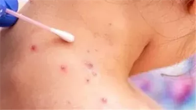 ظهور أول حالة لجدري القرود في الفلبين منذ ديسمبر الماضي 