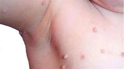 خطورة ظهور الثآليل عند الأطفال .. طبيبة توضح الأمر