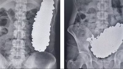 استخراج 3 كيلو مسامير من معدة شاب بإيران 