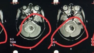 سوهاج الجامعى تنجح في استئصال 