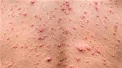 مدير عام الشئون الوقائية بمديرية الصحة بالإسكندرية.. لا وجود لجدرى القردة بالمحافظة 