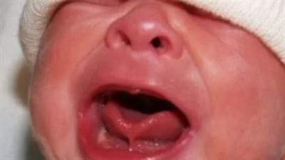 ماهي أعراض اللسان المربوط عند الرضع وطريقة علاجه