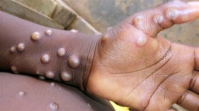  الصحة الأردنية تعلن  تسجيل إصابة بجدري القرود لشخص غير أردني مقيم في البلاد