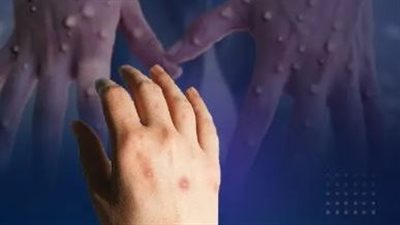 الصحة العالمية: الكونغو تواجه تفشي السلالتين الأولى والثانية من جدري القرود