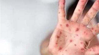 ما هي طرق العدوى بجدري القرود.. الصحة العالمية توضح 