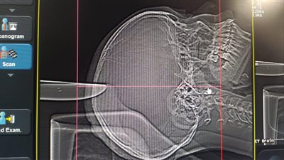 بعد طعنها بسكين في الرأس.. تفاصيل نجاح جراحة دقيقة لطفلة بالأقصر 