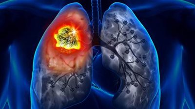 لأول مرة.. مريض في المملكة المتحدة يتلقى لقاحا مبتكرا لسرطان الرئة