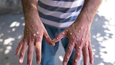 ارتفاع حالات الإصابة بجدري القردة في نيجيريا إلى 48 حالة