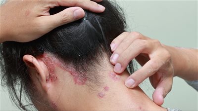 أسباب الصدفية وطرق علاجها| استراتيجيات فعّالة للتعامل معها