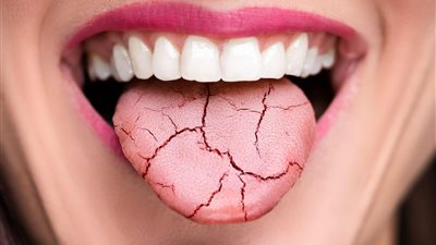 طبيب يكشف العلاقة بين متلازمة توقف التنفس أثناء النوم وجفاف الفم