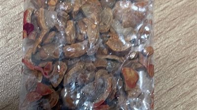 كفر شكر التخصصي تستخرج 75 حصوة من كلى مسن