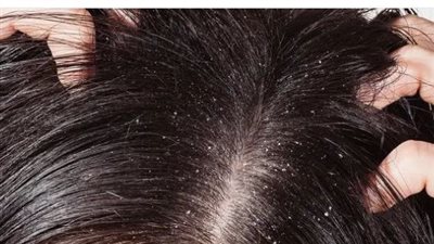 أسباب زيادة قشرة الشعر فى الشتاء