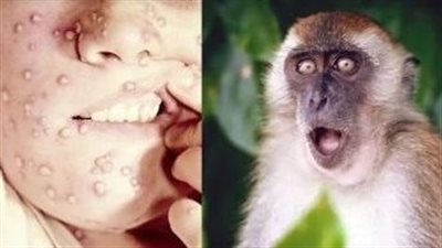 تطورات جدري القرود بالقارة السمراء.. نقص الاختبارات يدق ناقوس الخطر 