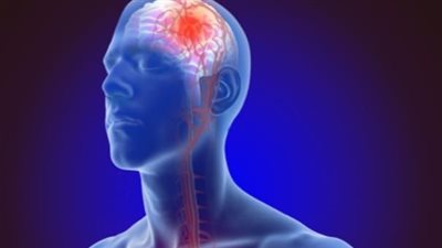  الثوم والشوكولاتة.. منتجات للوقاية من السكتة الدماغية