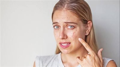 طبيبة أمراض جلدية تكشف سبب حب الشباب على الوجه