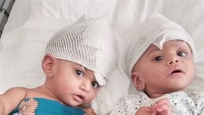 نجاح عملية فصل توأم ملتصق من الرأس بعد 14 ساعة 