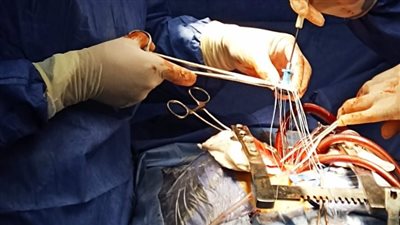  صحة الشرقية: إجراء جراحة قلب مفتوح عالية الخطورة بمستشفى الزقازيق العام