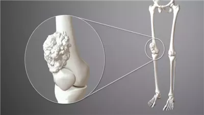علماء يطورون علاج جديد لسرطان العظام