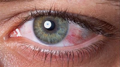 جفاف العين.. أسبابها وطرق العلاج لضمان الراحة والرؤية الواضحة