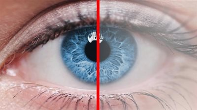 أضرار الإهمال في علاج إعتام عدسة العين