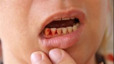 نصائح فعالة للحفاظ على صحة اللثة والوقاية من النزيف