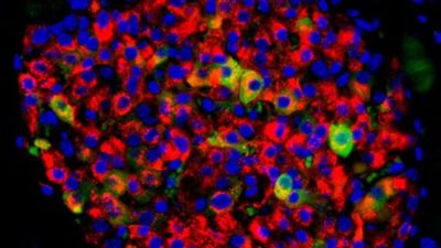 شفاء مريضة بـ السكري بعد أول عملية زرع خلايا جذعية في العالم