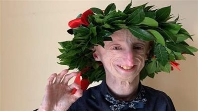 رحيل سامي باسو: رمز الأمل في مواجهة مرض البرجرية 