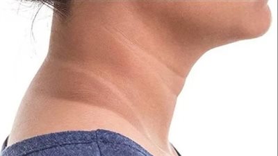 أسباب إسمرار مناطق في الجسم والعوامل المؤثرة