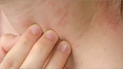 طبيبة تكشف أسباب الإصابة بالأكزيما وطرق علاجها