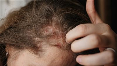 لماذا تتزايد قشرة الرأس في فصل الشتاء؟ أسباب غير متوقعة