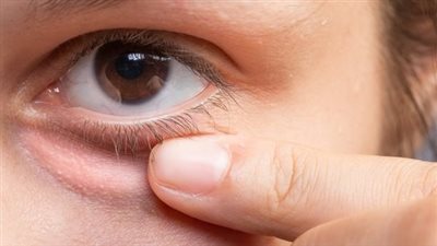 أسباب انتفاخ أسفل العين وطرق علاجها