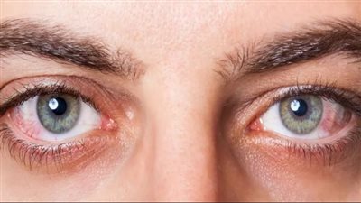 جفاف العين.. أسبابه وطرق الوقاية للحفاظ عليها