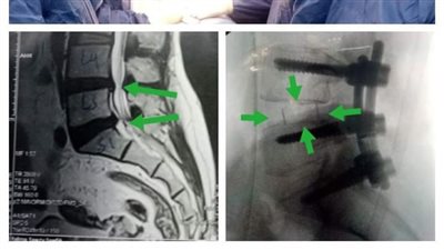 فريق جراحى بكفر شكر التخصصى ينقذ مريضة من الإصابة بالشلل بعد تركيب قفص كربوني