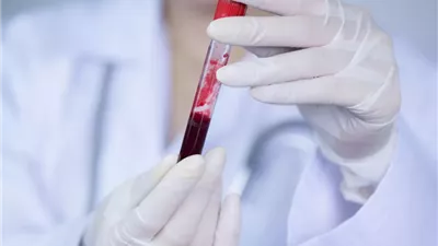 فصيلة دم تزيد من خطر الإصابة بسكتة دماغية