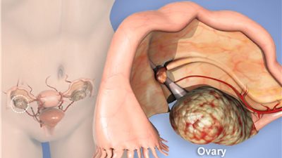 باحثون يتمكنون من تحديد أصل سرطان المبيض 