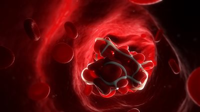 تطوير تقنية جديدة لتجنب الجلطات الدموية وتصلب الشرايين